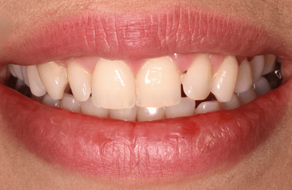 Before - brecknockdental