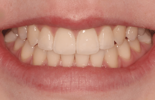 After - brecknockdental
