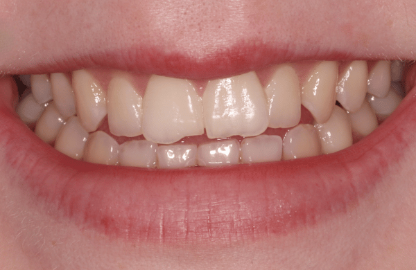 Before - brecknockdental