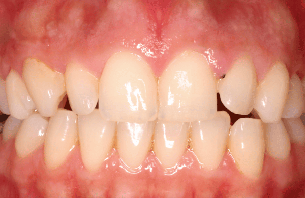 Before - brecknockdental