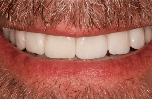 After - brecknockdental