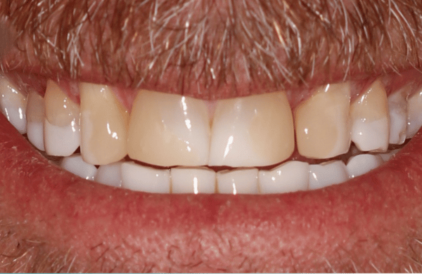 Before - brecknockdental